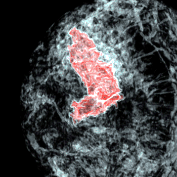 Image: Phase contrast CT scan of a breast sample (Photo courtesy of ESRF-LMU/Brun).